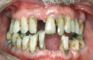 Chronic periodontitis can drive systemic inflammation by reprogramming the bone marrow neutrophils