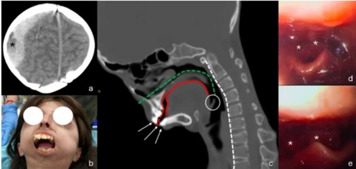 Traumatic Epidural Hematoma in Hutchinson-Gilford Progeria Syndrome