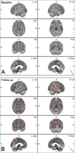 Recurrent Brain Trauma May Increase Alzheimer’s Risk