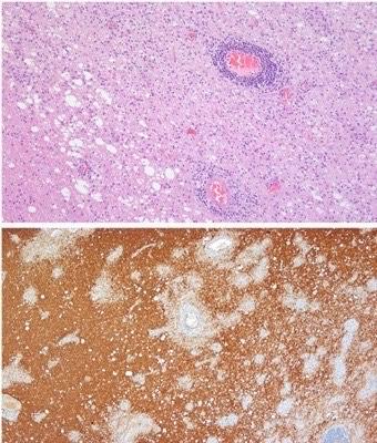 Not All Multiple Sclerosis-like Diseases are Alike