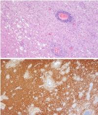 Not All Multiple Sclerosis-like Diseases are Alike