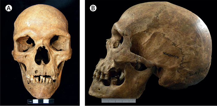 Oldest case of a rare genetic condition discovered