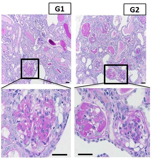 Scarred Kidney Filtering cells