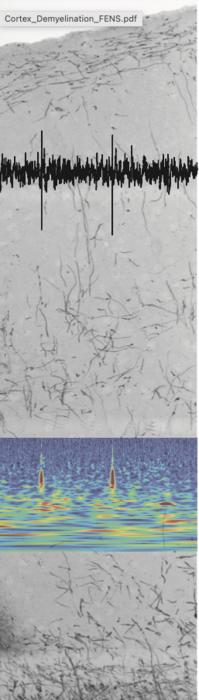 Demyelinated somatosensory cortical column
