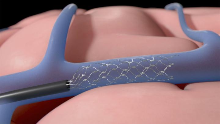 Stentrode™ Device
