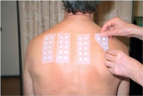 A person tested for contact allergy
