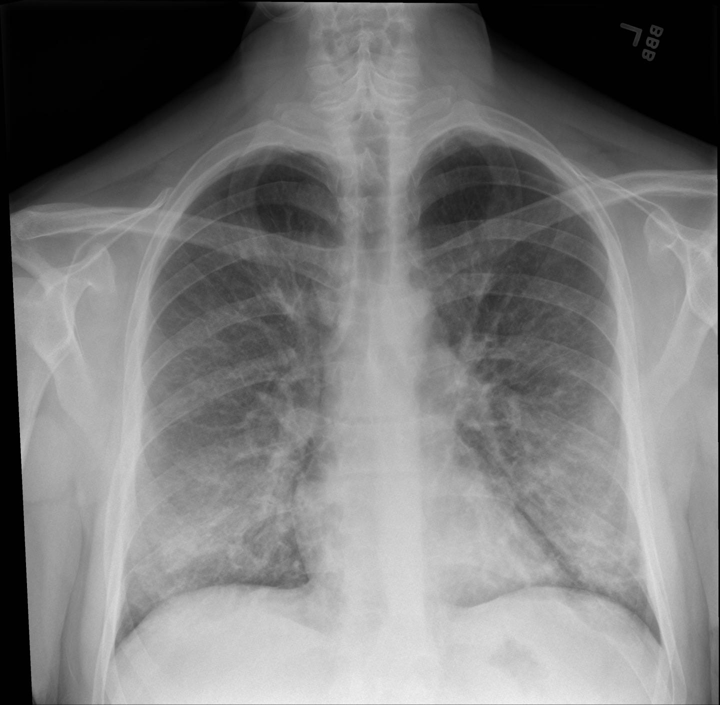 Vaping X-Ray