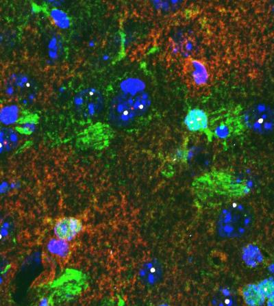 New Target for Huntington's Disease?