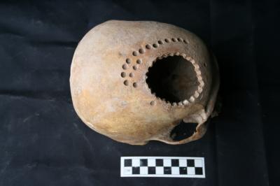 Trepanned Skull