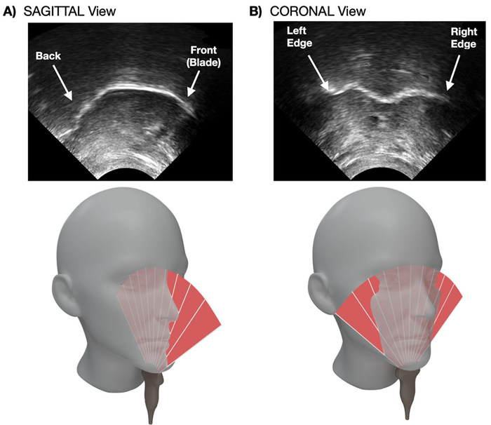 Real-time visual feedback of the tongue in sagittal (A) and coronal (B) plane