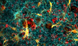 Confocal - Cancer cells and fibroblasts in collagen 1.tif