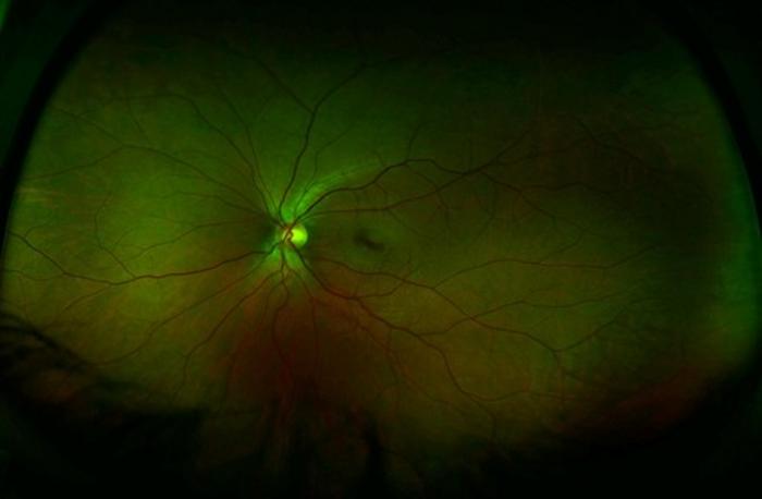 Progressive Retinal Degeneration Under Prolonged Light Exposure