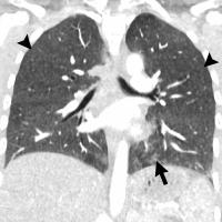 Abnormal Imaging Findings Key to EVALI Diagnosis in Vapers (3 of 3)