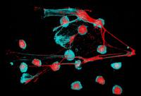 White Blood Cells and NETs in a Lupus Patient