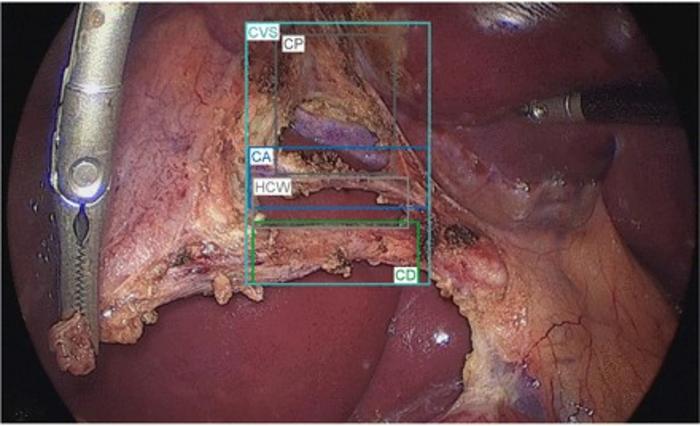 Real-time detection of the cystic artery (blue box), cystic duct (green box), and hepatocystic window (gray box) by the AI algorithm. CA, cystic artery; CD, cystic duct; CP, cystic plate; CVS, critical view of safety; HCW, hepatocystic window.