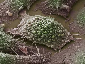 Scanning electron microscope image of a lung cancer cell.