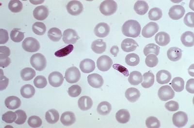 Malaria