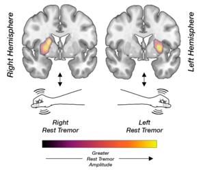 Rest tremor and brain dopamine function