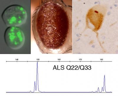 A Genetic Risk Factor for ALS
