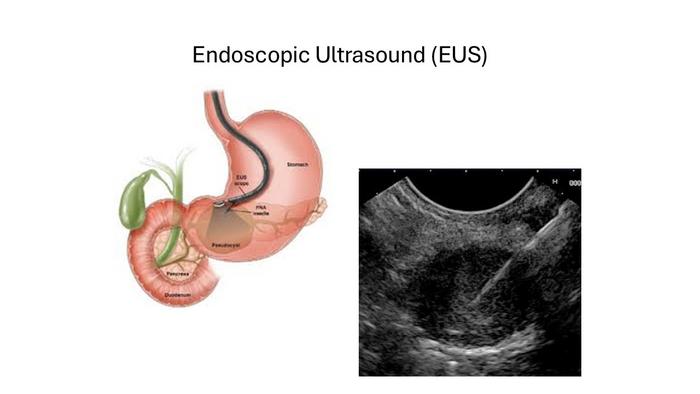 Endoscopic Ultrasound
