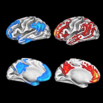 Plaques and the Resting Brain