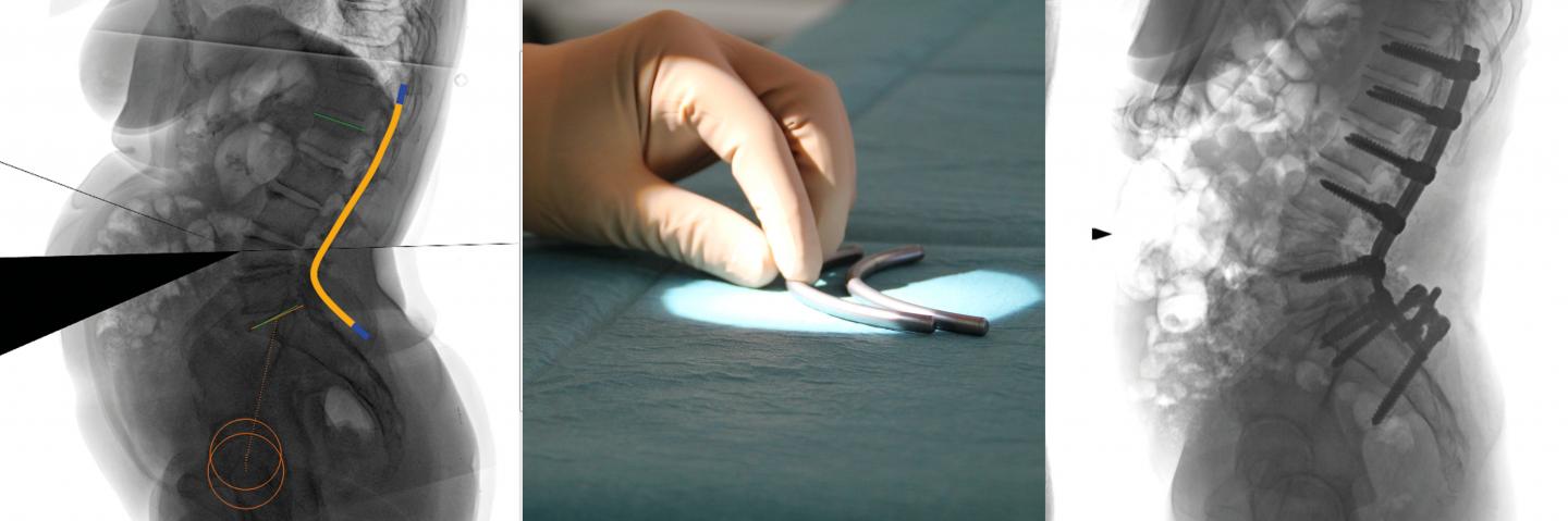 UNiD Patient-Specific Rod