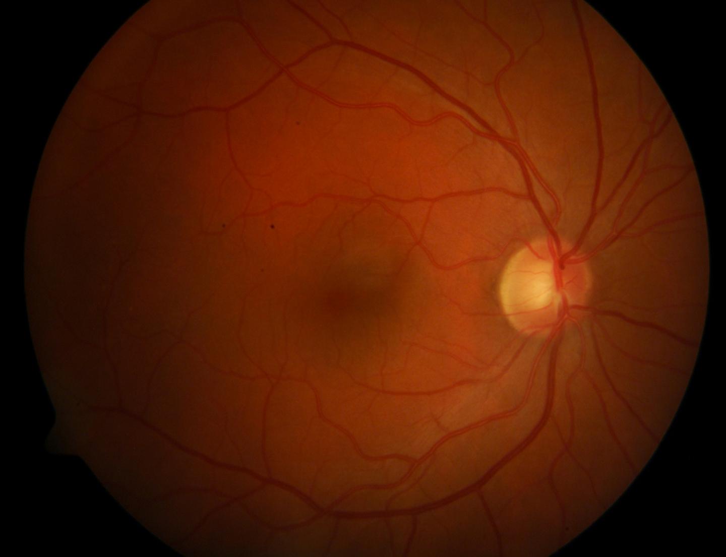 Healthy Retina