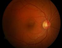 Healthy Retina