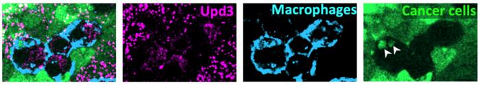 Macrophages consuming dying cancer cells and releasing inflammatory cytokines