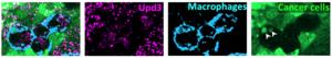 Macrophages consuming dying cancer cells and releasing inflammatory cytokines