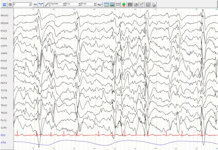Chaos in the Brain